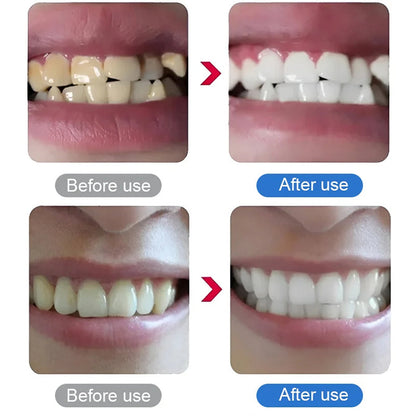 💎UP TO 50% OFF!!🦷✨Electric Ultrasonic Dental Scaler for Tartar and Plaque Removal